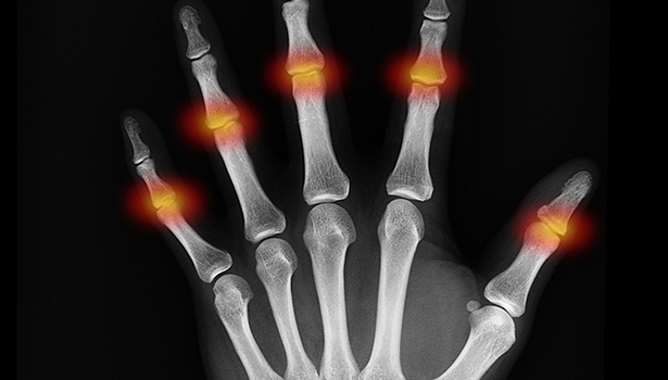 Die Ern&auml;hrung kann den Verlauf von Rheuma mit beeinflussen. In einer &Uuml;bersicht stellen Forscher die aktuellen Kenntnisse dazu vor.