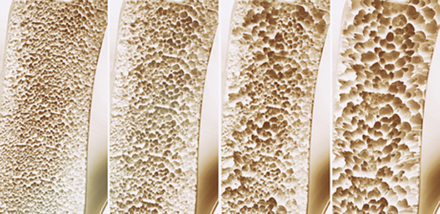 Auf die Gesundheit der Knochen hat die Ern&auml;hrung einen deutlichen Einfluss, wie eine Auswertung der seit vielen Jahren durchgef&uuml;hrten Rotterdam-Studie zeigt.