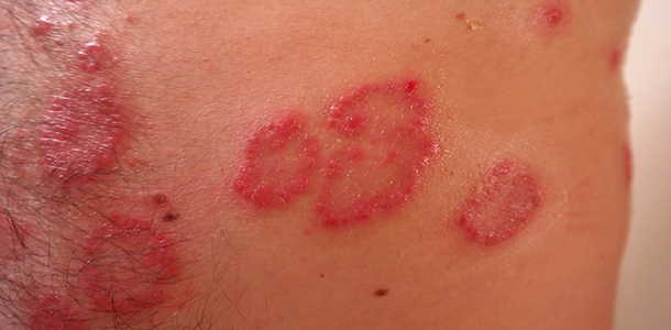 Eine ungesunde Ern&auml;hrung kann die Schuppenflechte (Psoriasis) deutlich verst&auml;rken. Dabei spielen das &Uuml;bergewicht und die zu hohe Aufnahme an ges&auml;ttigten Fetts&auml;uren eine wichtige Rolle.